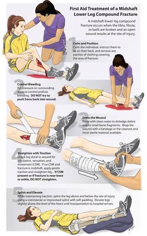 First Aid In case of a Fracture